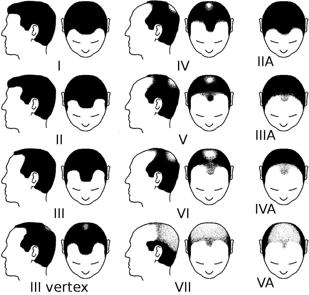 7 stadiów rozwoju łysienia androgenowego u mężczyzn